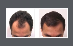 neograft-before-after