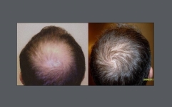 before-after-neograft-top