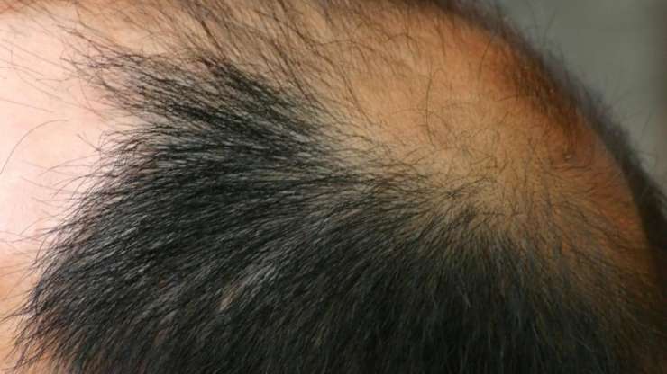 4 Things to Know About Getting Services for Hair Restoration in West Palm Beach