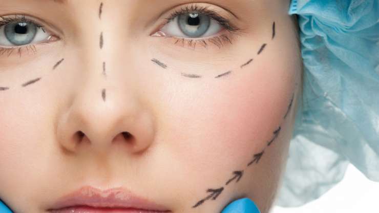 Vivace Micro-needling RF in Boynton Beach
