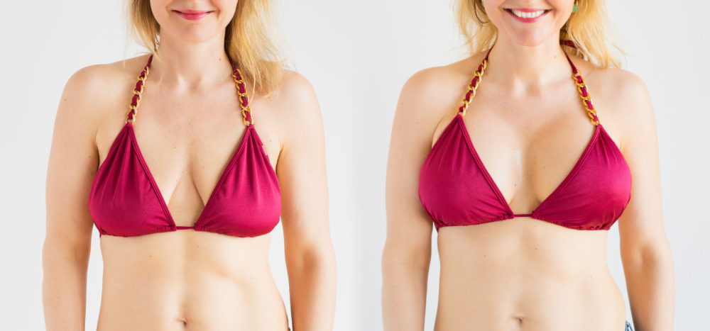 Where Can I Get a Mommy Makeover in Boynton Beach?