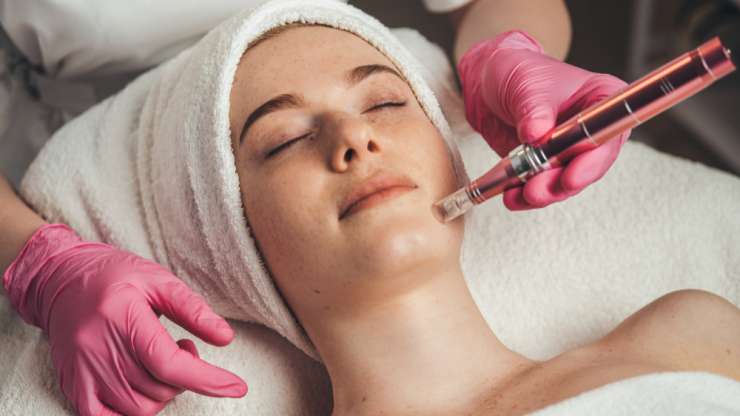 Vivace Microneedling RF Wellington FL